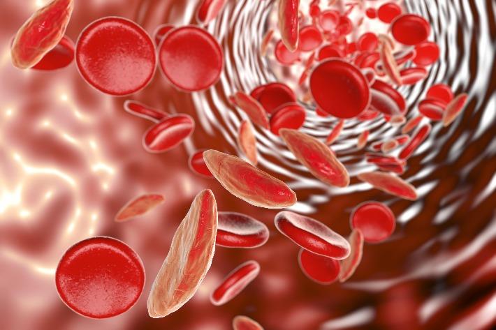 אילוסטרציה: תאי דם אדומים בחולה אנמיה 