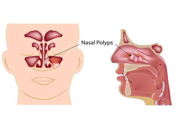 איור המדמה התפתחות של פוליפים באף 