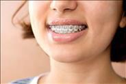 יישור שיניים לילדים -בריאות שיניים ואסתטיקה