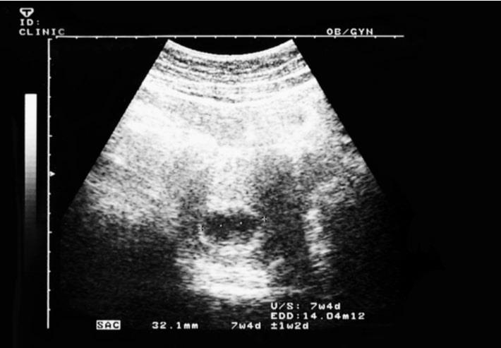צילום של אולטרסאונד ראשון בשבוע 7 להריון