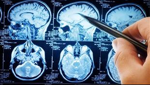ממצאים אקראיים בבדיקות הדמיה מוחיות: מתי כדאי לטפל?