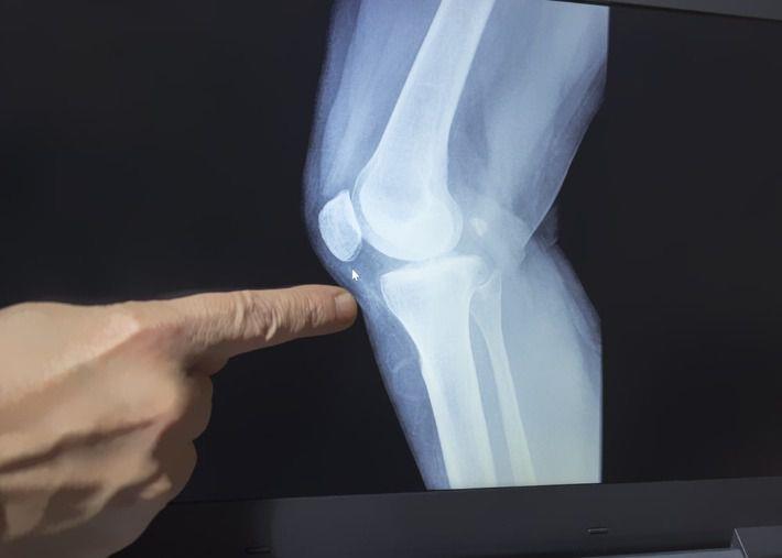 רופא בודק צילום רנטגן כדי לאבחן שבר בברך 