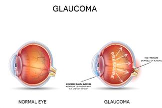 טיפולים בגלאוקומה: הכירו את החידושים האחרונים בטיפול שעשויים למנוע עיוורון