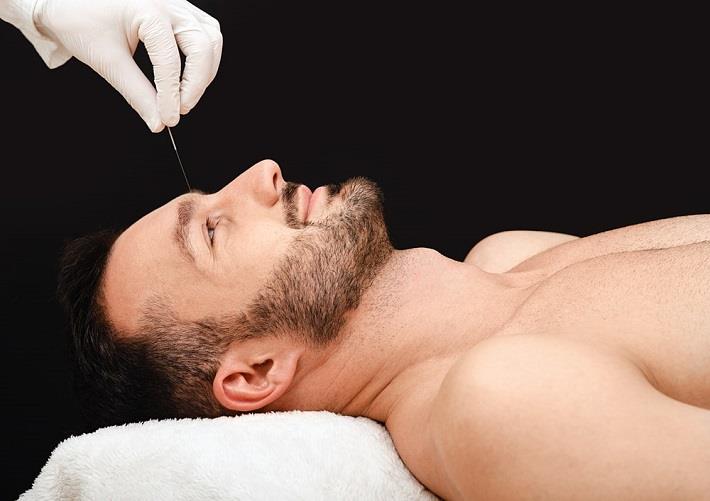גבר שוכב על מיטת טיפולים ועובר דיקור סיני לכאבי ראש ומיגרנה