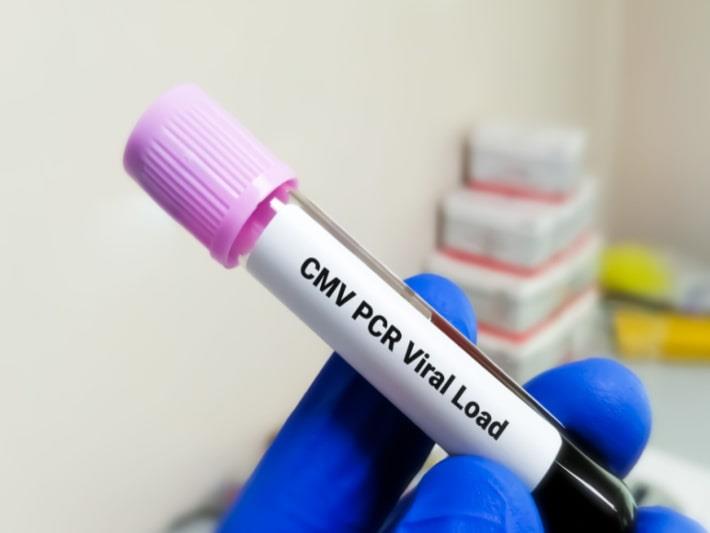 מבחנה עם בדיקת דם PCR CMV, ואלגנציקלוביר