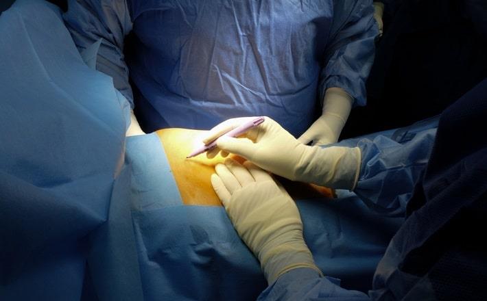 כירורגית מסמנת חתכים על בטן אדם שעומד לעבור ניתוח כריתת טחול בחדר ניתוח
