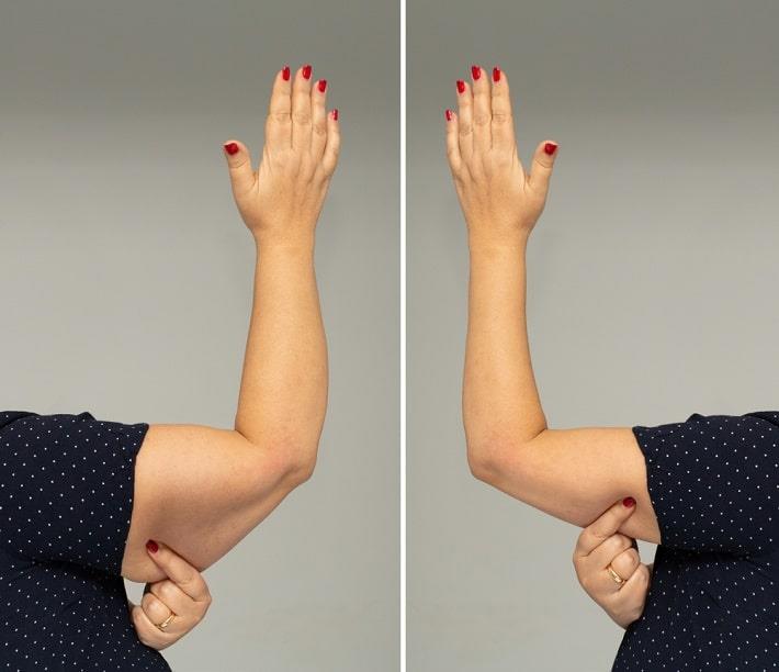 זרוע של אישה לפני ואחרי ניתוח מתיחת זרועות
