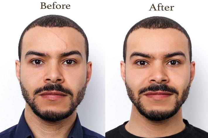 פנים של בחור לפני ואחרי הליך העלמת צלקת