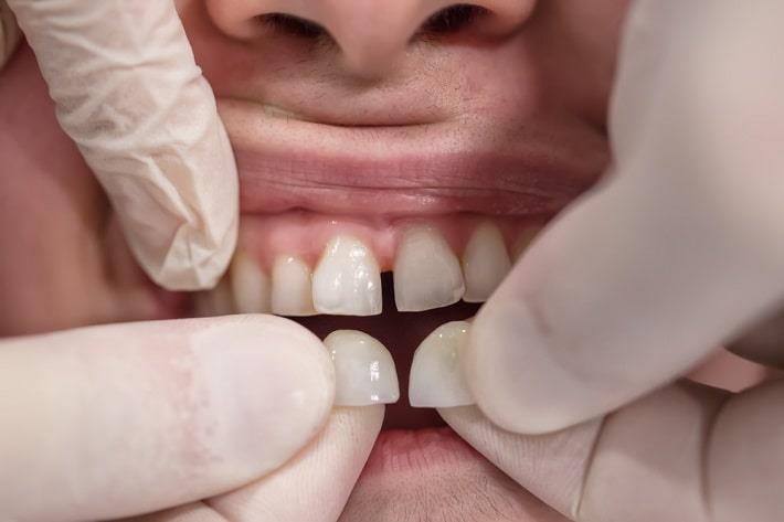 ידיים עם כפפות מבצעות הדבקה של ציפוי שיניים במטופל עם רווח בשיניים